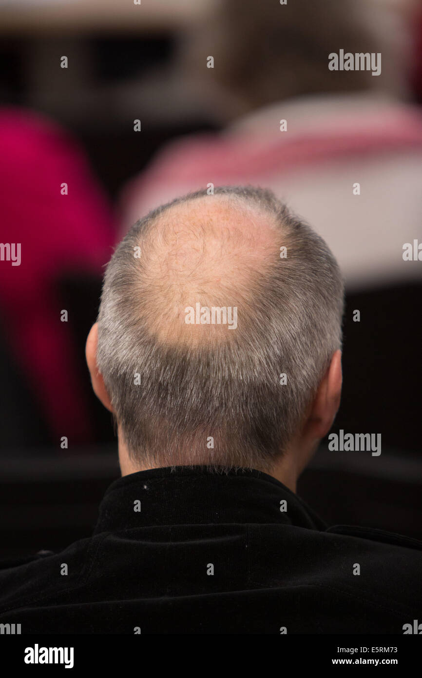 Mann mit männlichen Haarausfall (Alopezie). Stockfoto