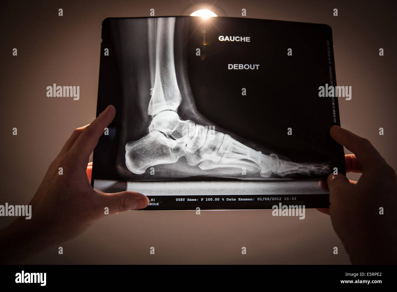 Röntgenbild eines Fußes nach der operativen Behandlung von Ballen (Hallux valgus) betroffen. Stockfoto