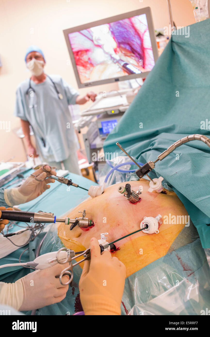 Chirurgen eine laparoskopische Sleeve-Gastrektomie, Limoges Krankenhaus durchführen. Stockfoto