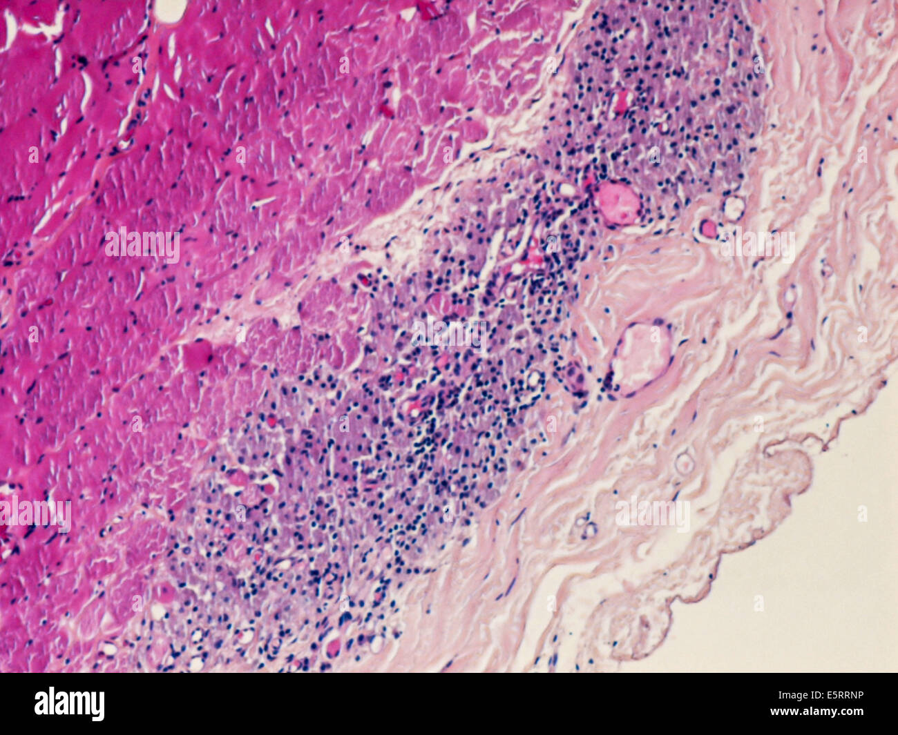 Leichte Schliffbild eines Abschnitts durch Gewebe aus einem Musculus deltoideus Biopsie zeigt eine macrophagic Myofasciitis nach der Impfung. Stockfoto
