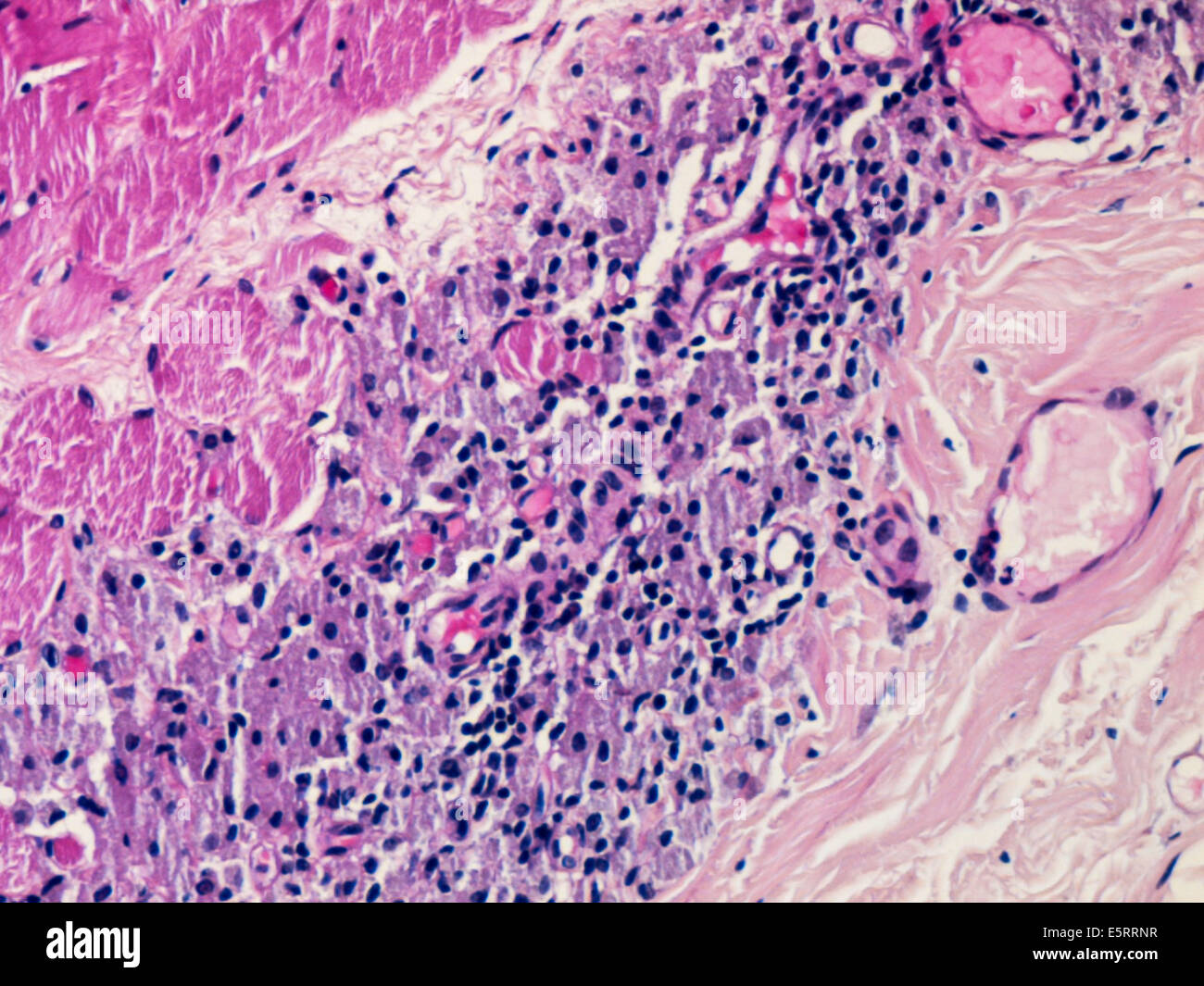 Leichte Schliffbild eines Abschnitts durch Gewebe aus einem Musculus deltoideus Biopsie zeigt eine macrophagic Myofasciitis nach der Impfung. Stockfoto