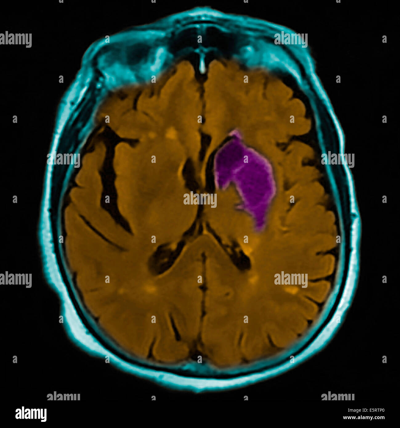Farbige Magnetresonanz-Bildgebung (MRI)-Scan und CT eine axiale Schnitt durch das Gehirn des Patienten, zeigt den Schaden Stockfoto