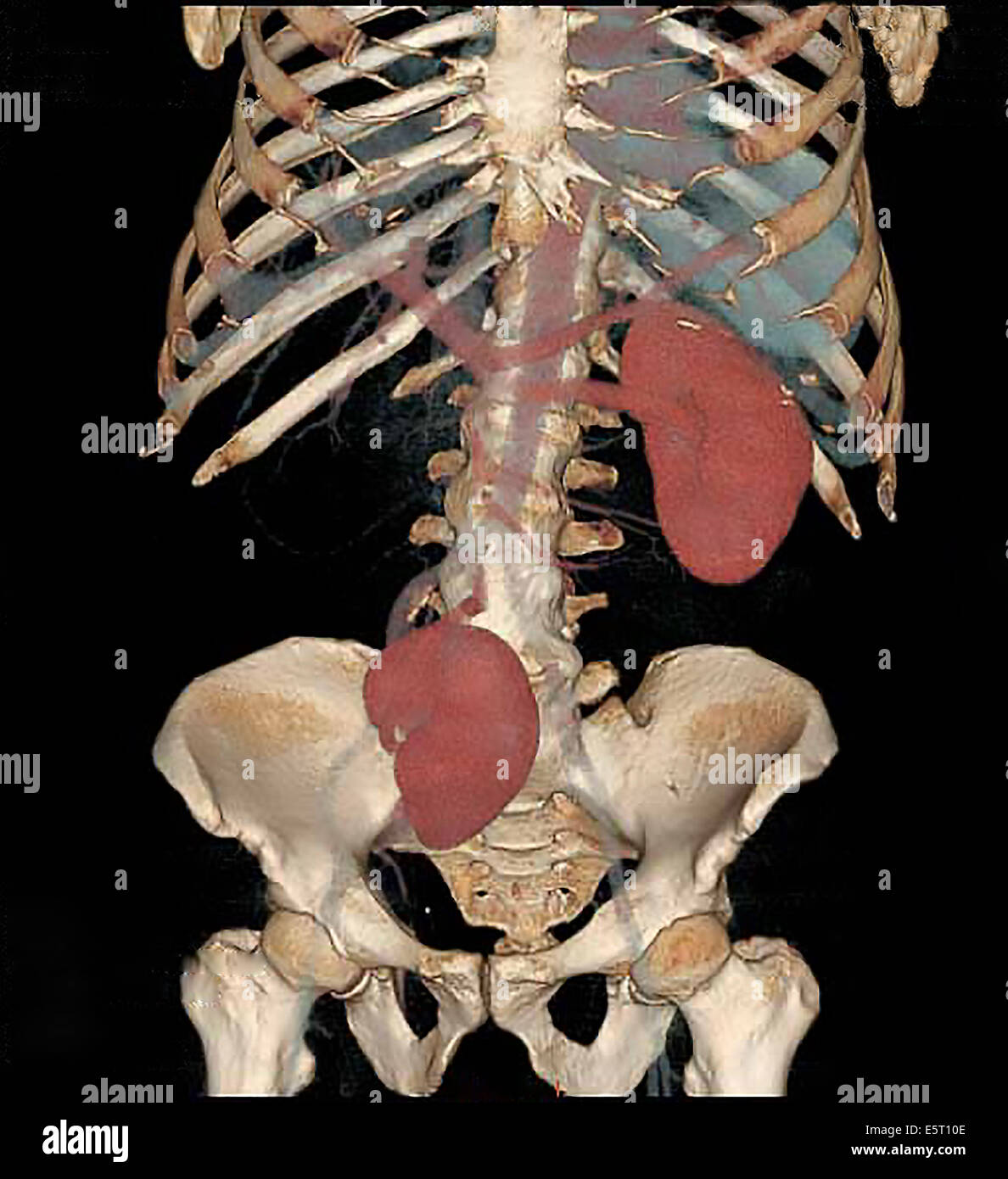 Farbige 3-d Computertomographie (CT)-Scan eine einseitige ektopische Niere im Becken. Stockfoto