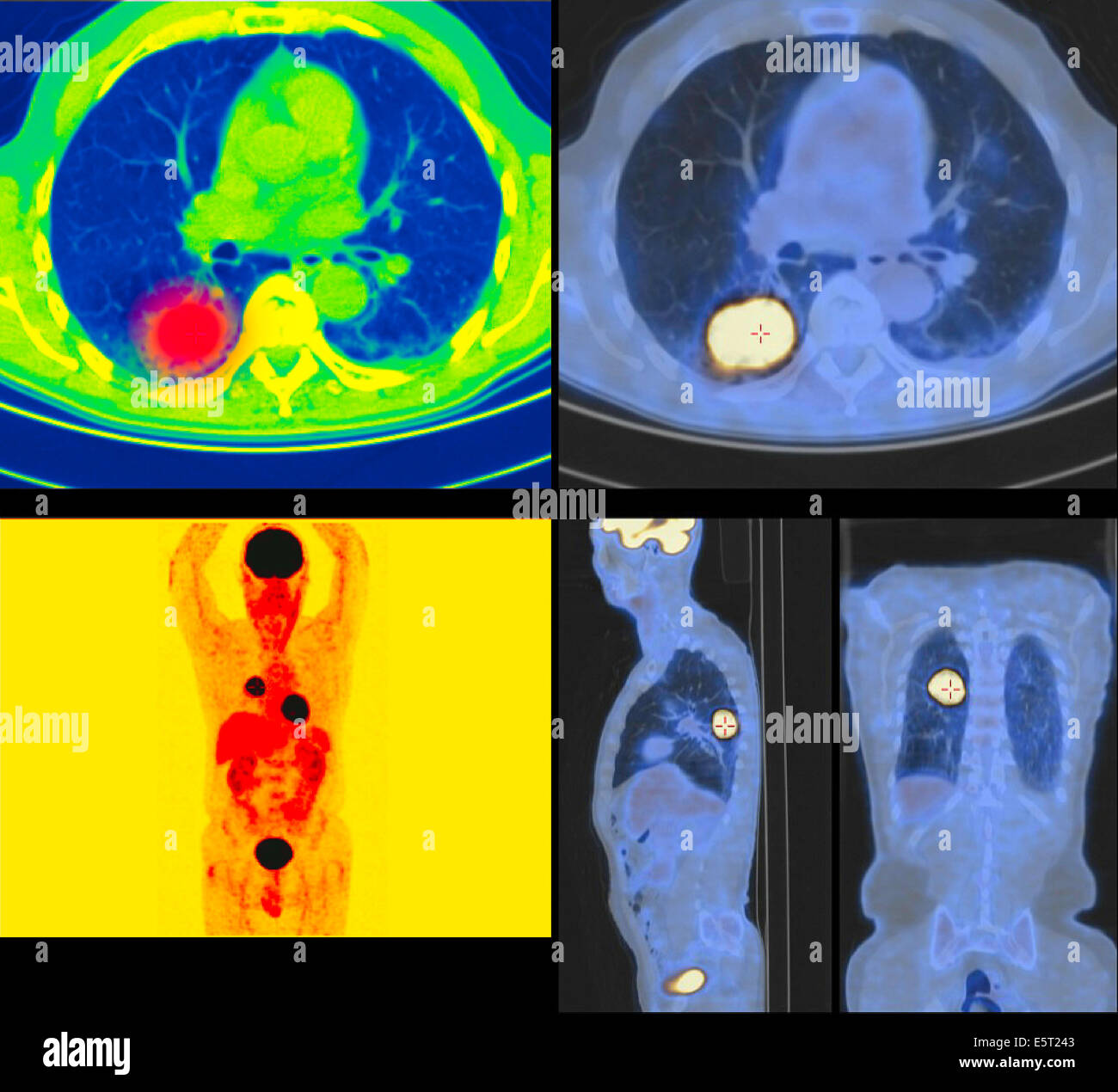 Positronen-Emissions-Tomographie (PET) Scans eines Patienten mit einem Tumor der oberen Lappen der linken Lunge. Stockfoto