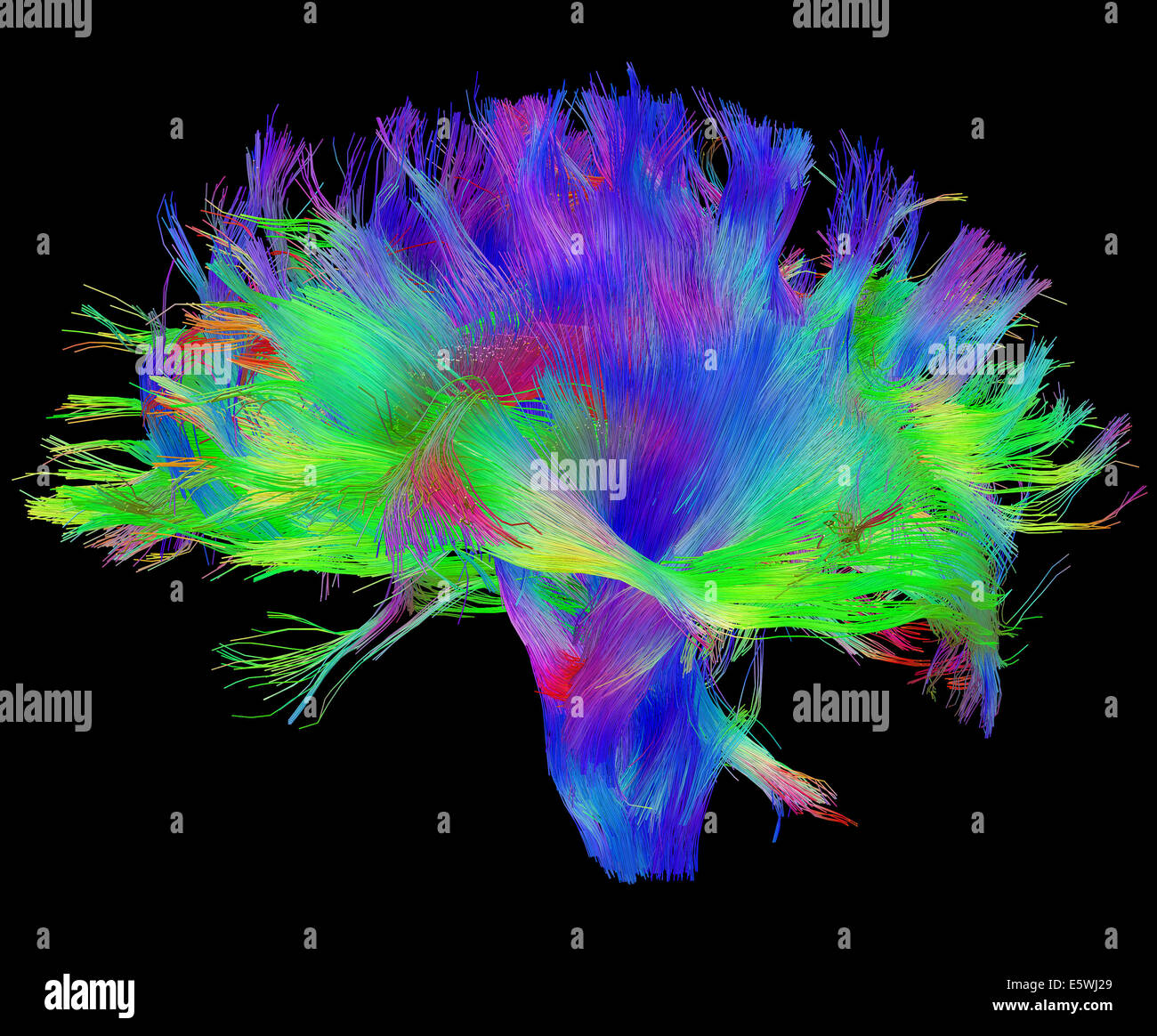 Verbreitung mri zeigt weiße Substanz Architektur Stockfoto