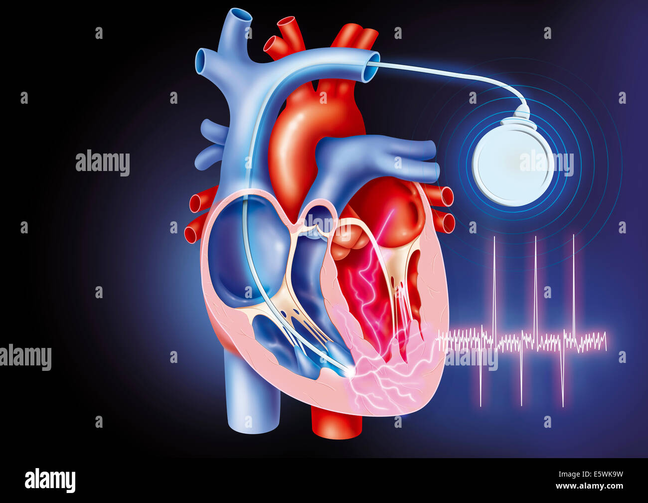 Herzschrittmacher Stockfoto