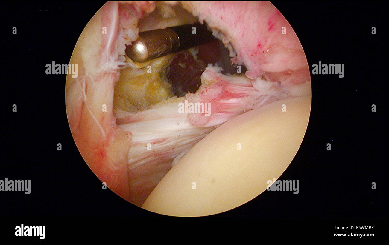 Schulter, Arthroskopie Stockfoto