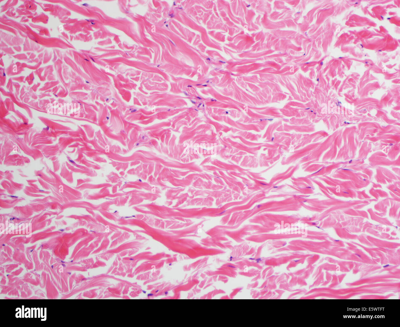 H & E Fleck, Lichtmikroskopie, reichlich Kollagen in ein Fibrom Gardner Stockfoto
