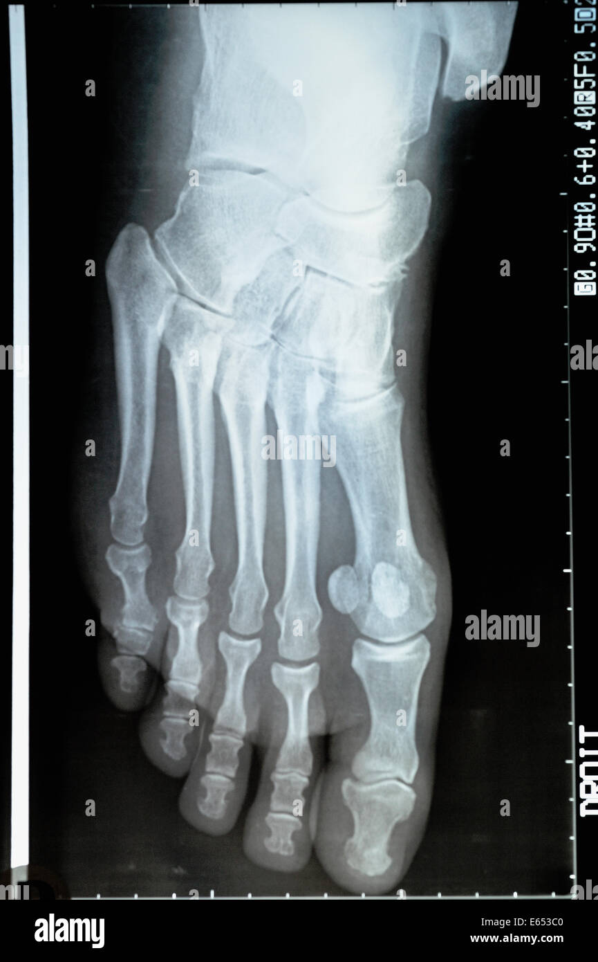 Röntgenbild des Fußes eine reife Frau Stockfoto