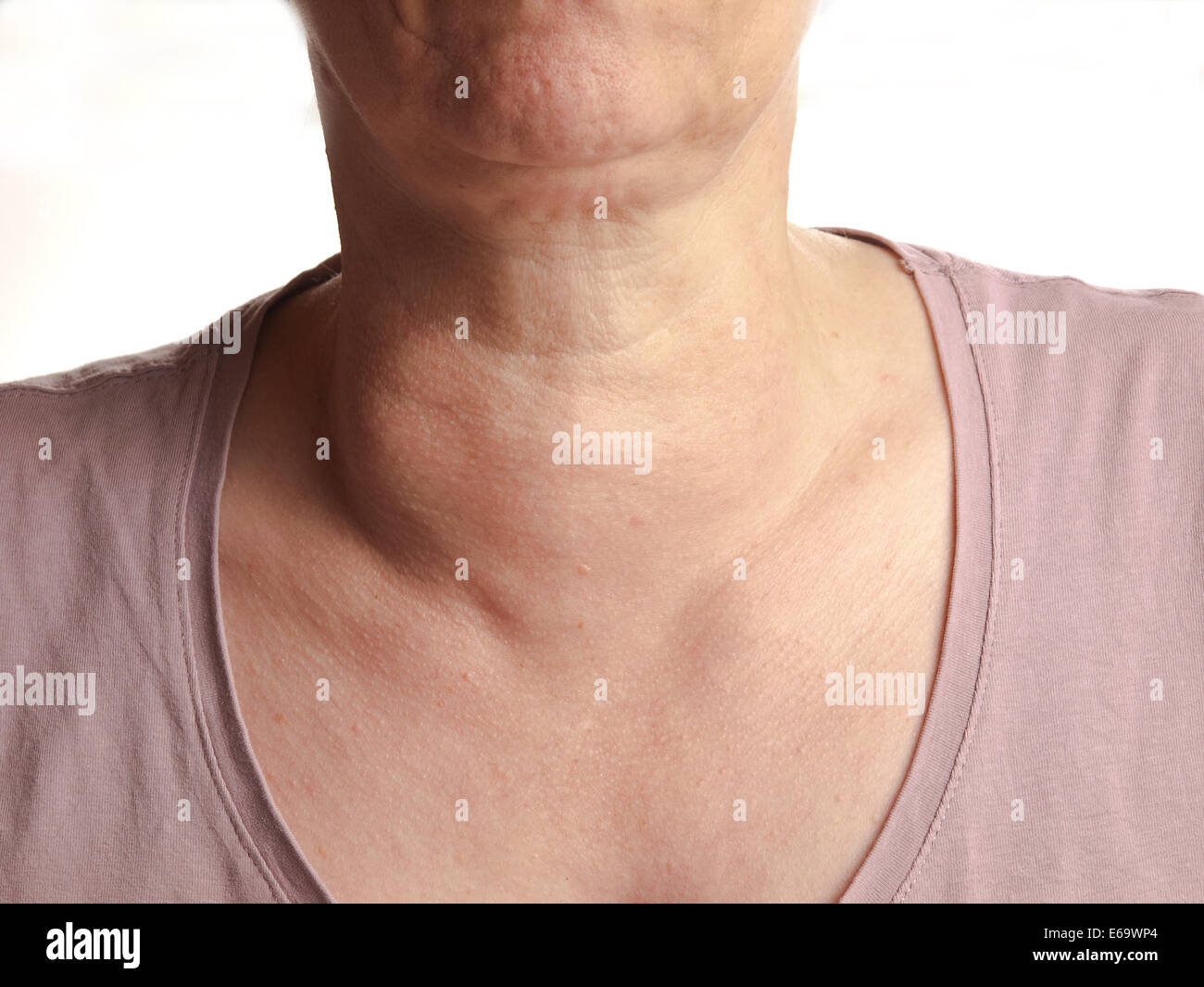 Schilddrüse, Kropf Stockfotografie Alamy