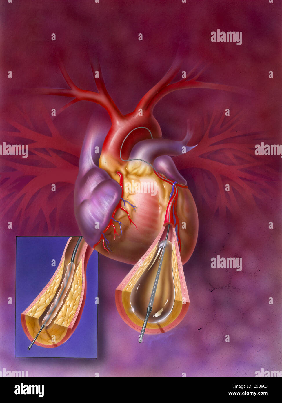 Einfügen von Ballon in atherosklerotischen Arterie. Stockfoto