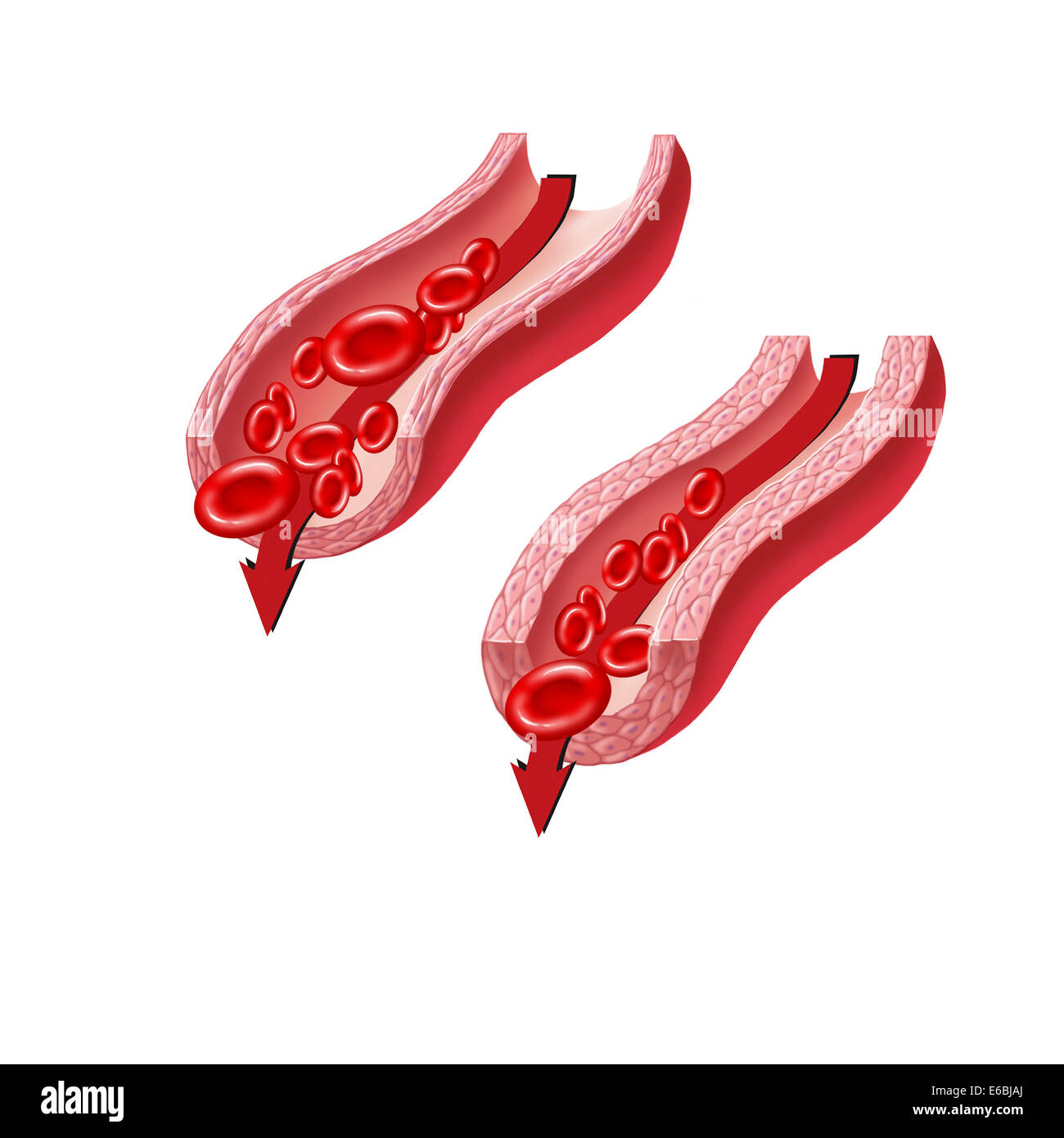 Durchblutung durch eine entspannte Arterie Verus eine Arterie im Krampf. Stockfoto
