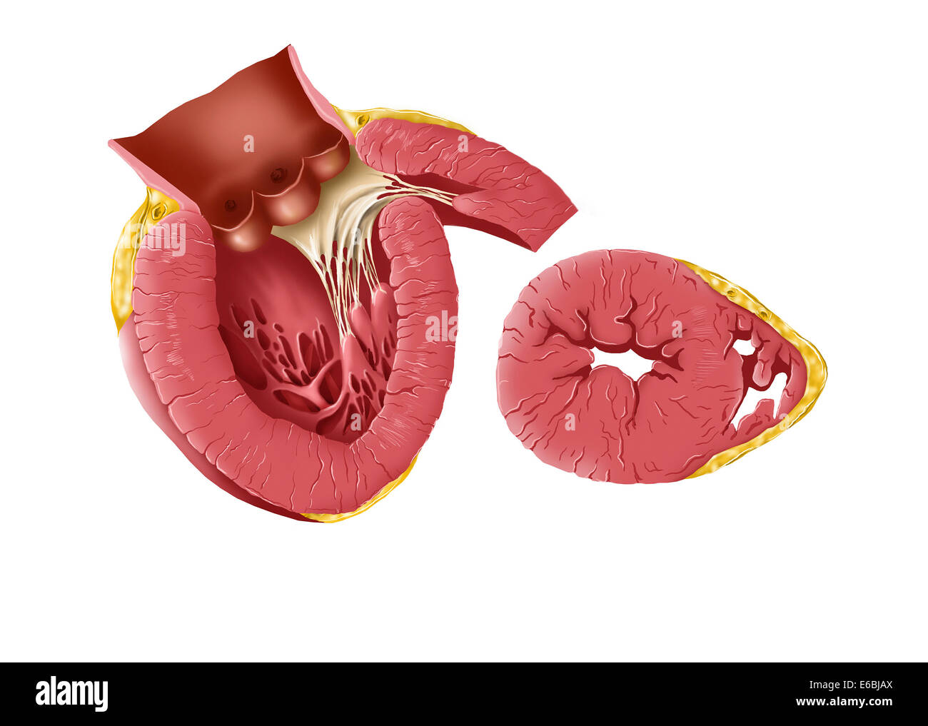 Vergrößerte linke Herzkammer des menschlichen Herzens. Stockfoto