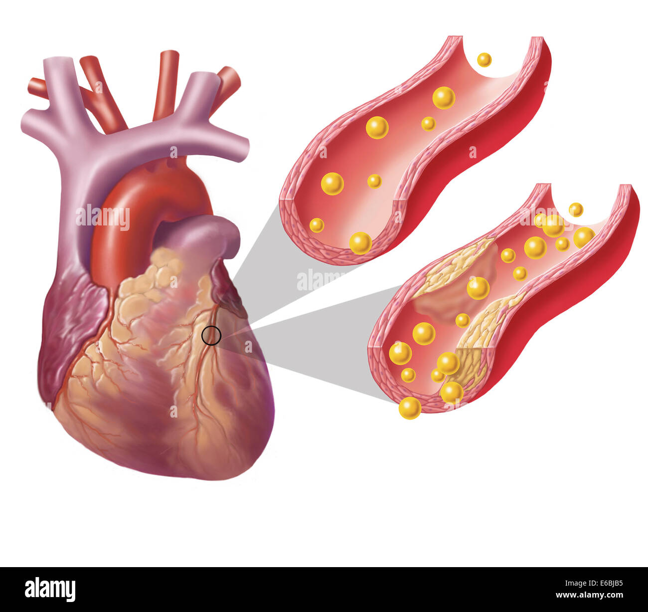 Herz mit Arterien Cholesterin in eine Arterie und atherosklerotischen Plaques in den anderen zu zeigen. Stockfoto