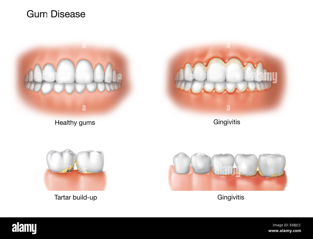 Vergleich von gesundem Zahnfleisch gegen Gingivitis. Stockfoto