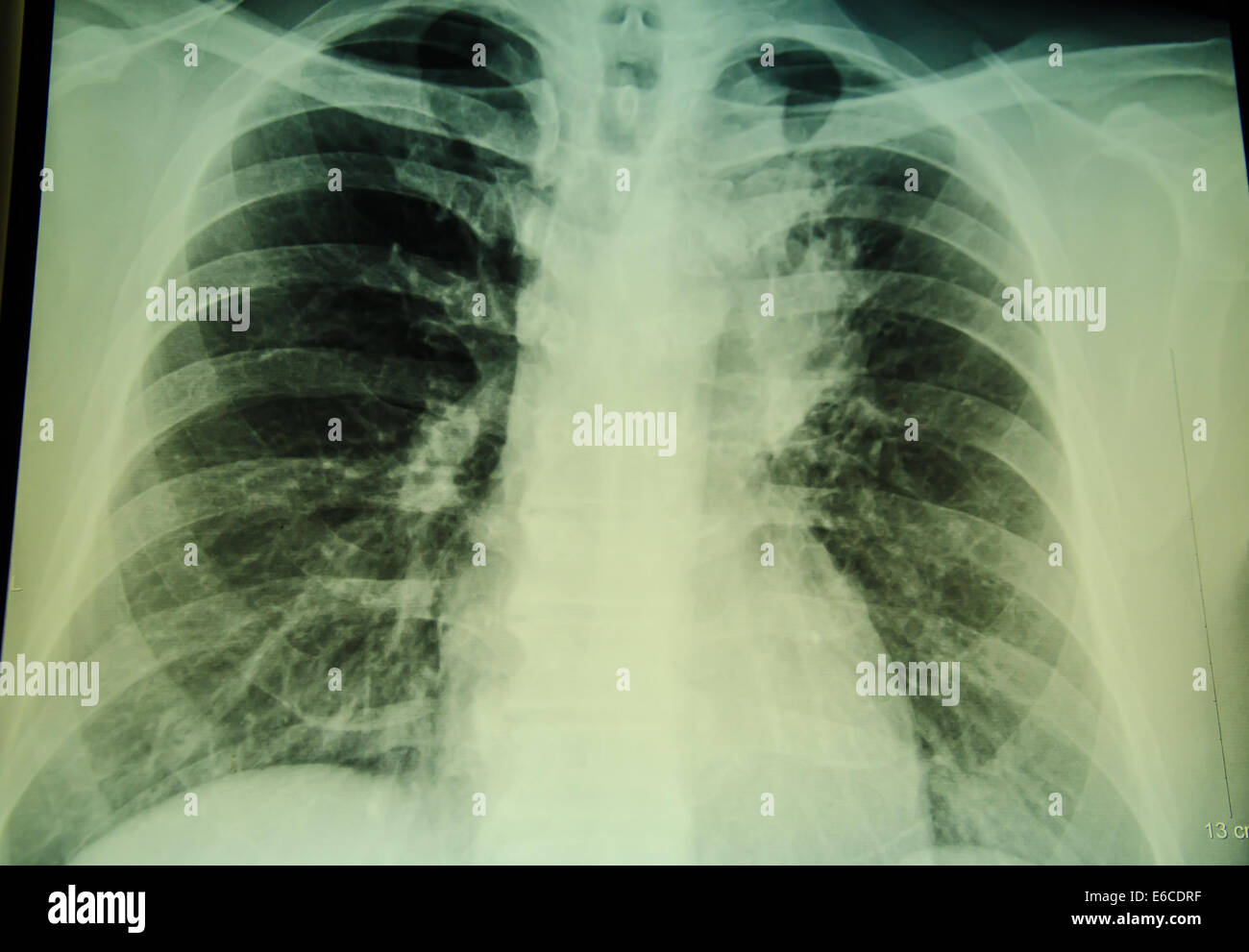 Röntgenuntersuchung der Brust für die Diagnose Stockfoto