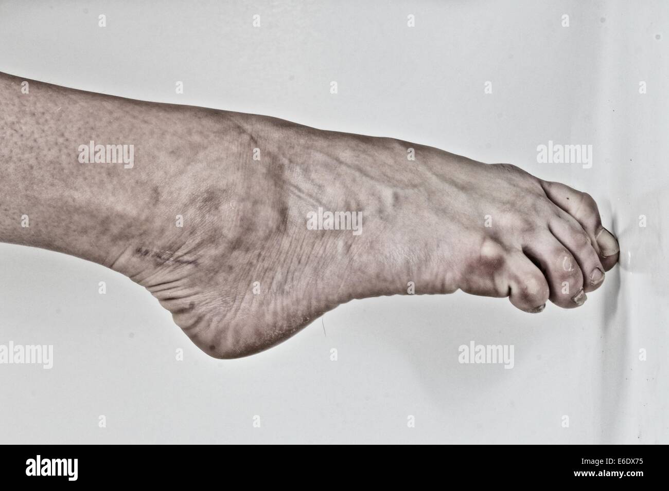 Damage Feet Stockfotos Und Bilder Kaufen Alamy
