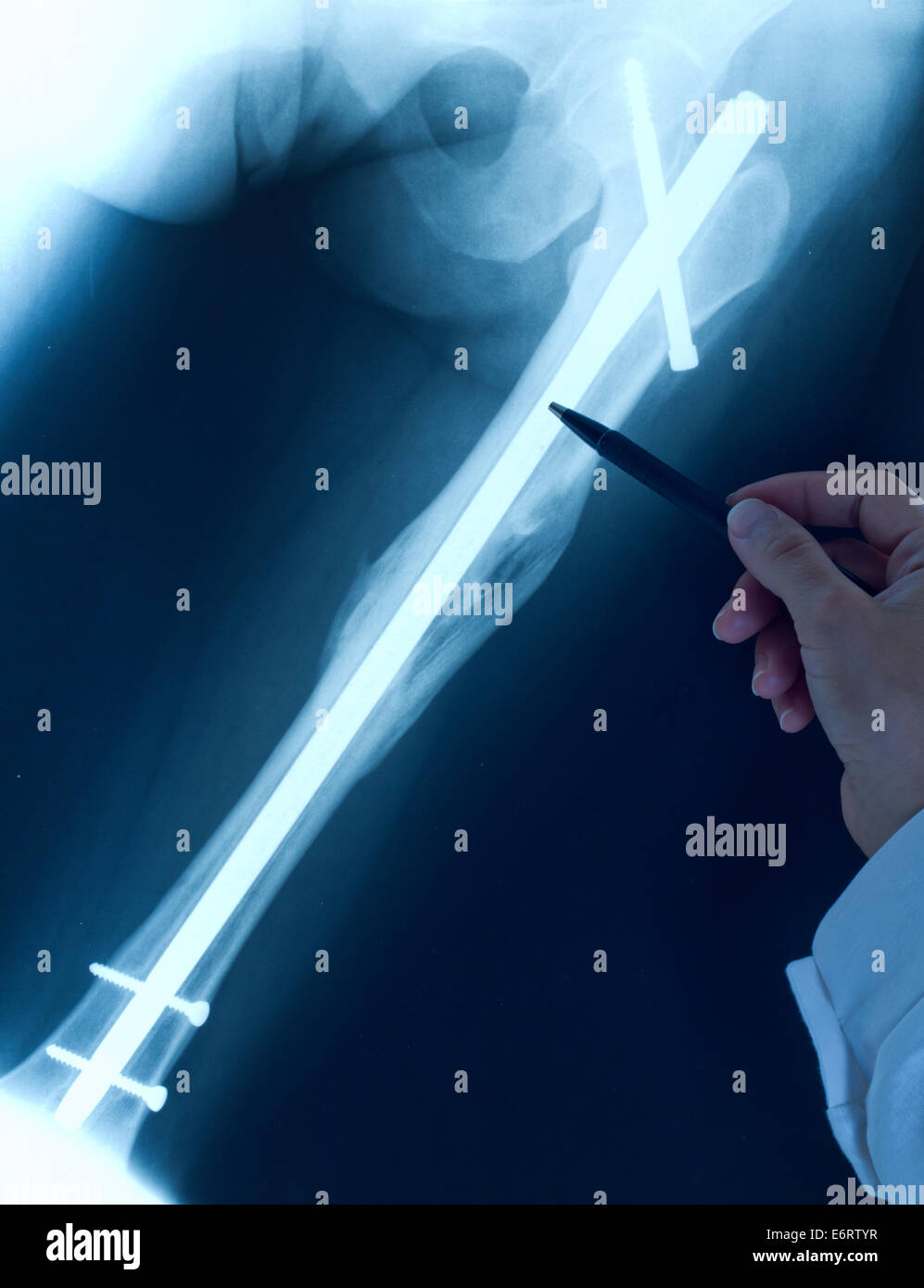 Arzt Orthopäde untersuchen Röntgen mit gebrochenem Bein nach der Operation Stockfoto