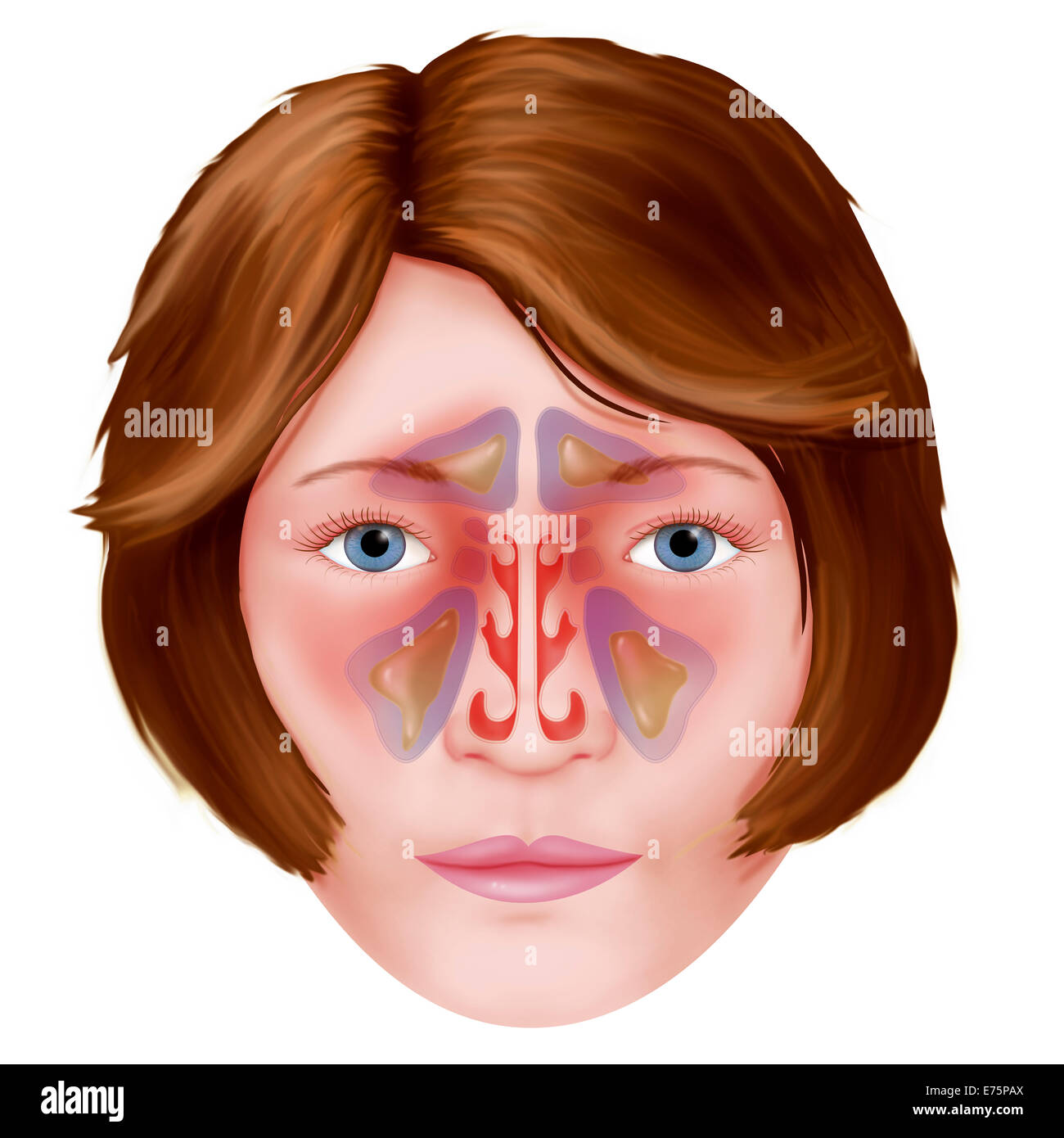 Sinusitis, Zeichnung Stockfoto