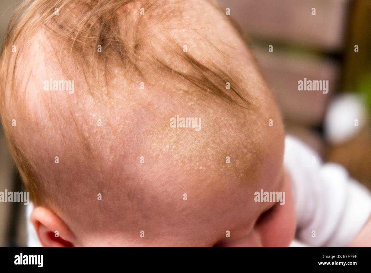 Eine sieben Wochen alte Bucht mit Milchschorf auf der Kopfhaut. VEREINIGTES KÖNIGREICH. Stockfoto