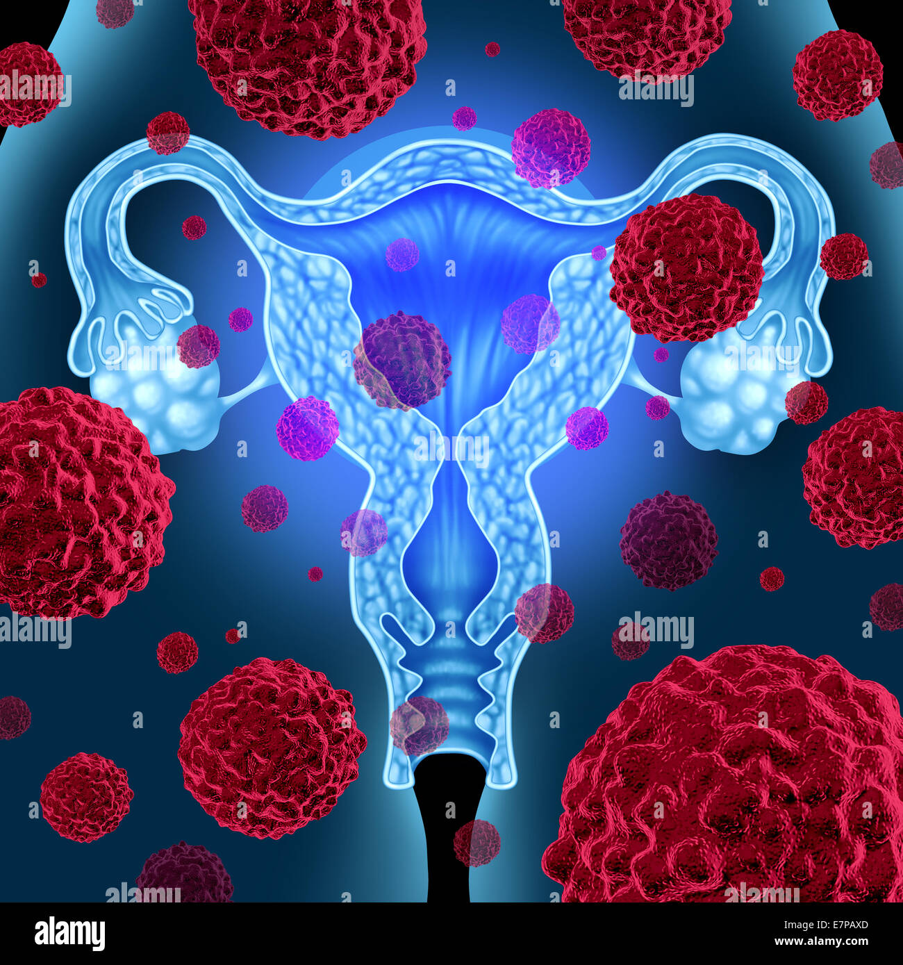 Gebärmutter oder Gebärmutterkrebs medizinisches Konzept als Krebszellen in einem weiblichen Körper angreifen der Geschlechtsorgane-Anatomie einschließlich der Eierstöcke und Eileiter als Gesundheitswesen Symbol der zervikalen Tumorbehandlung Wachstum und Risiken zu verbreiten. Stockfoto