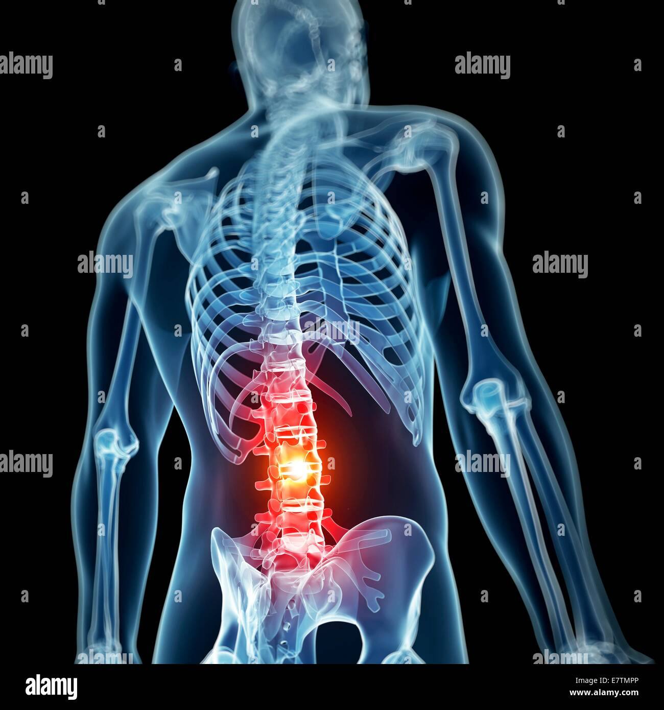Menschlichen Rückenschmerzen, Computer-Grafik. Stockfoto