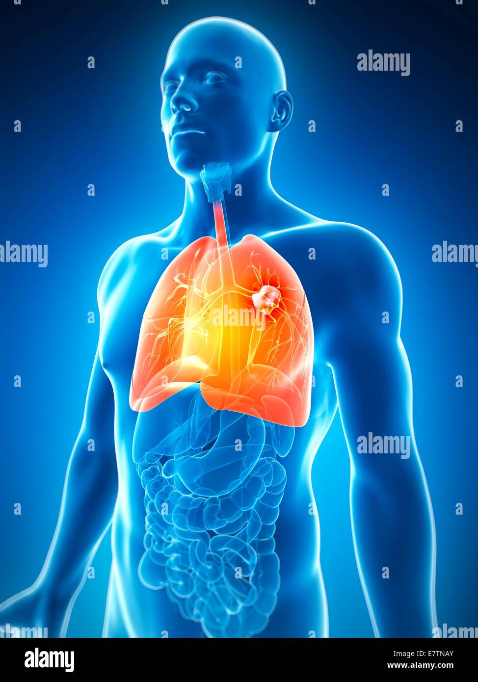 Menschlichen Lungenkrebs, Computer-Grafik. Stockfoto