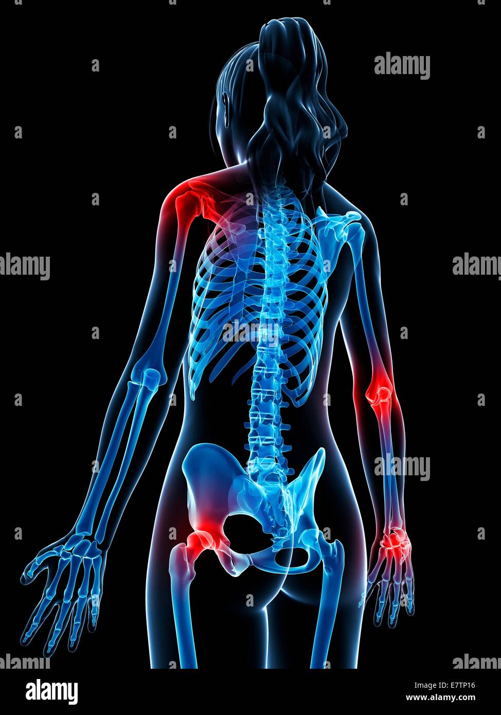 Menschliche Anatomie von entzündeten Gelenken, Computer-Grafik. Stockfoto