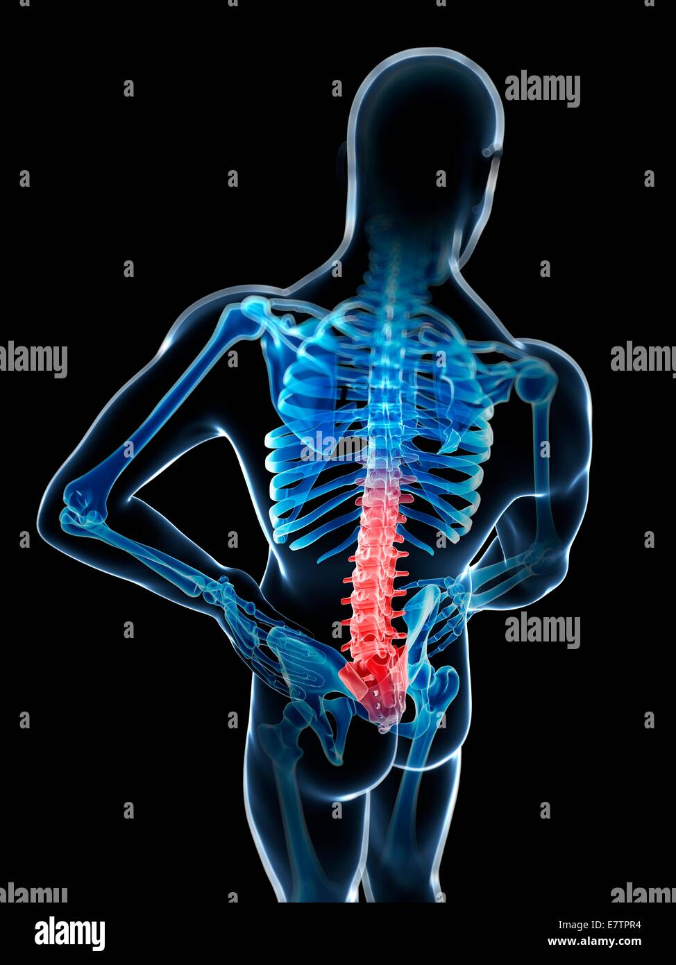 Menschlichen Rückenschmerzen, Computer-Grafik. Stockfoto