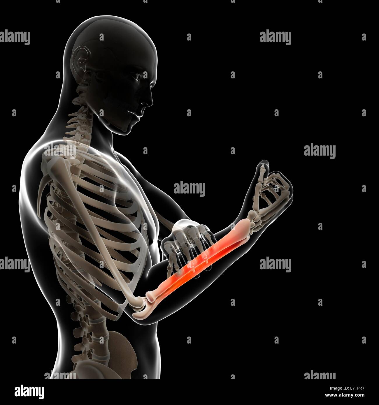 Menschlichen Arm-Schmerzen, Computer-Grafik. Stockfoto
