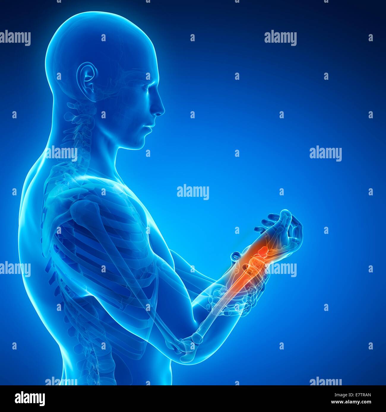 Menschlichen Handgelenk Schmerzen, Computer-Grafik. Stockfoto