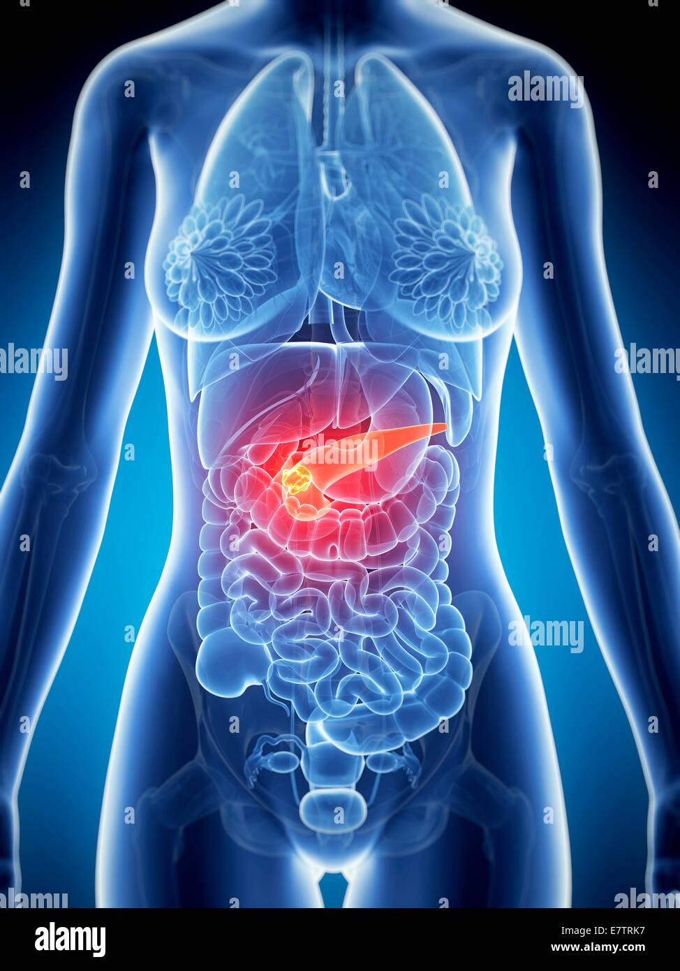 Weibliche Bauchspeicheldrüse zeigen Tumor, Computer-Grafik. Stockfoto