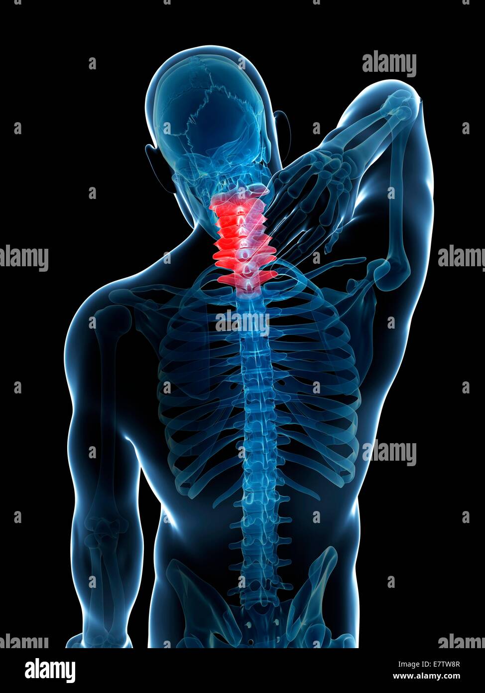 Menschlichen Nackenschmerzen, Computer-Grafik. Stockfoto