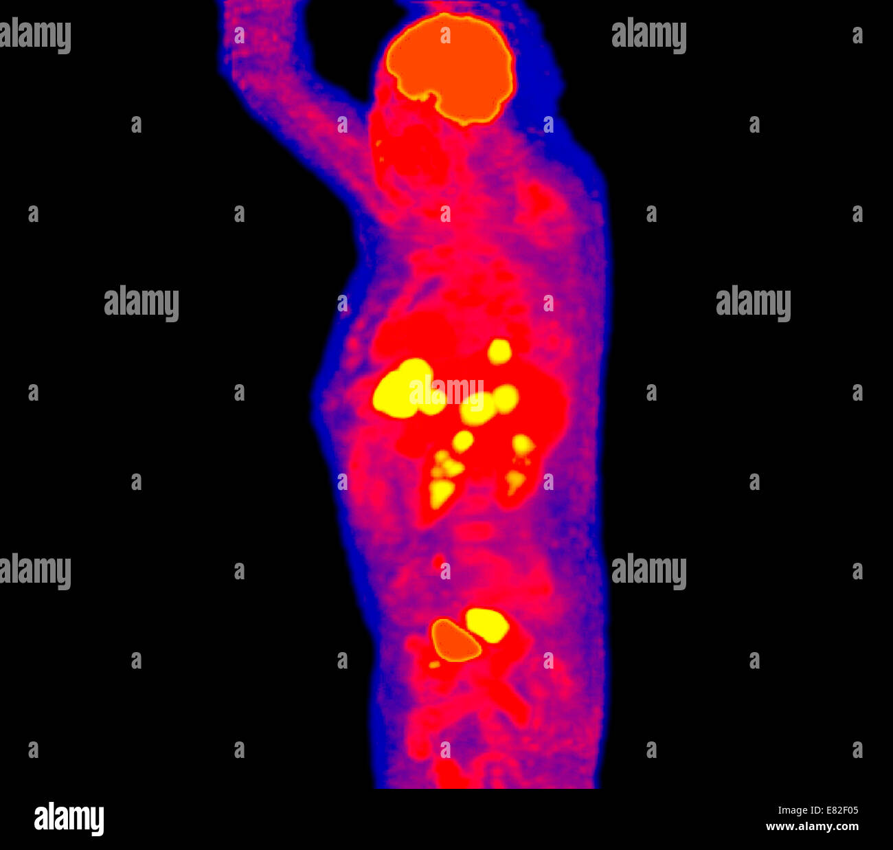 Positronen-Emissions-Tomographie (PET) Scans eines Patienten mit Mastdarmkrebs und hepatische Metastasen. Stockfoto