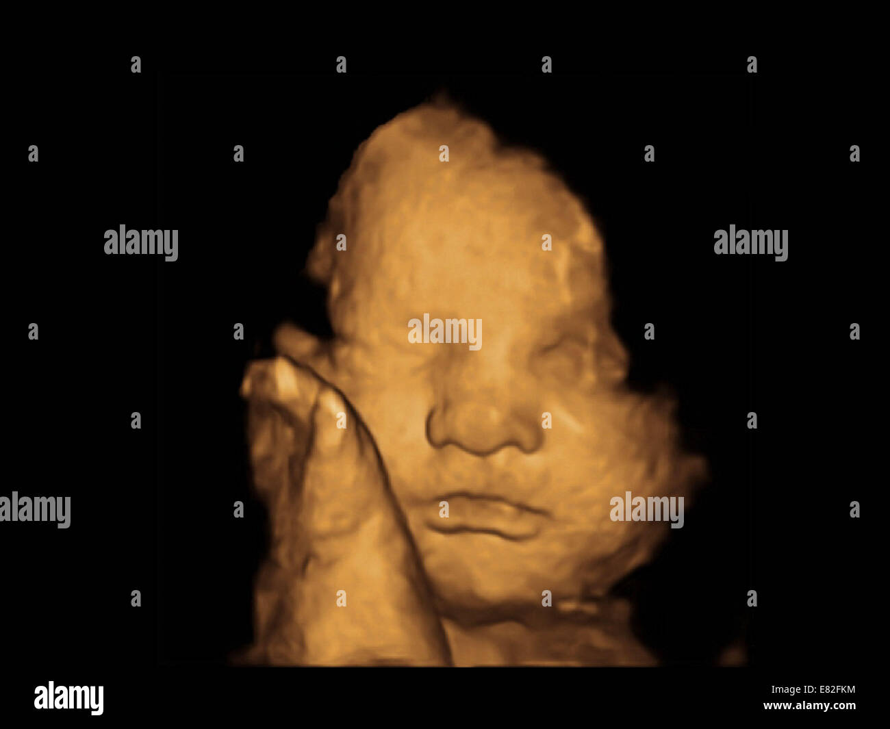 Fötus Gesicht, farbige 3-d-Ultraschalluntersuchung eines Fötus Gestational Alter: 32 Wochen und 4 Tage. Stockfoto