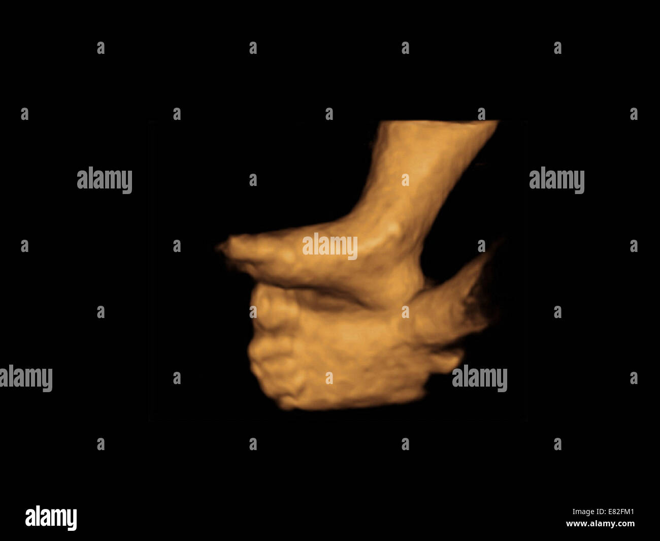 Foetus'foot, farbige 3-d-Ultraschalluntersuchung eines Fötus Gestational Alter: 31 Wochen und 4 Tage. Stockfoto