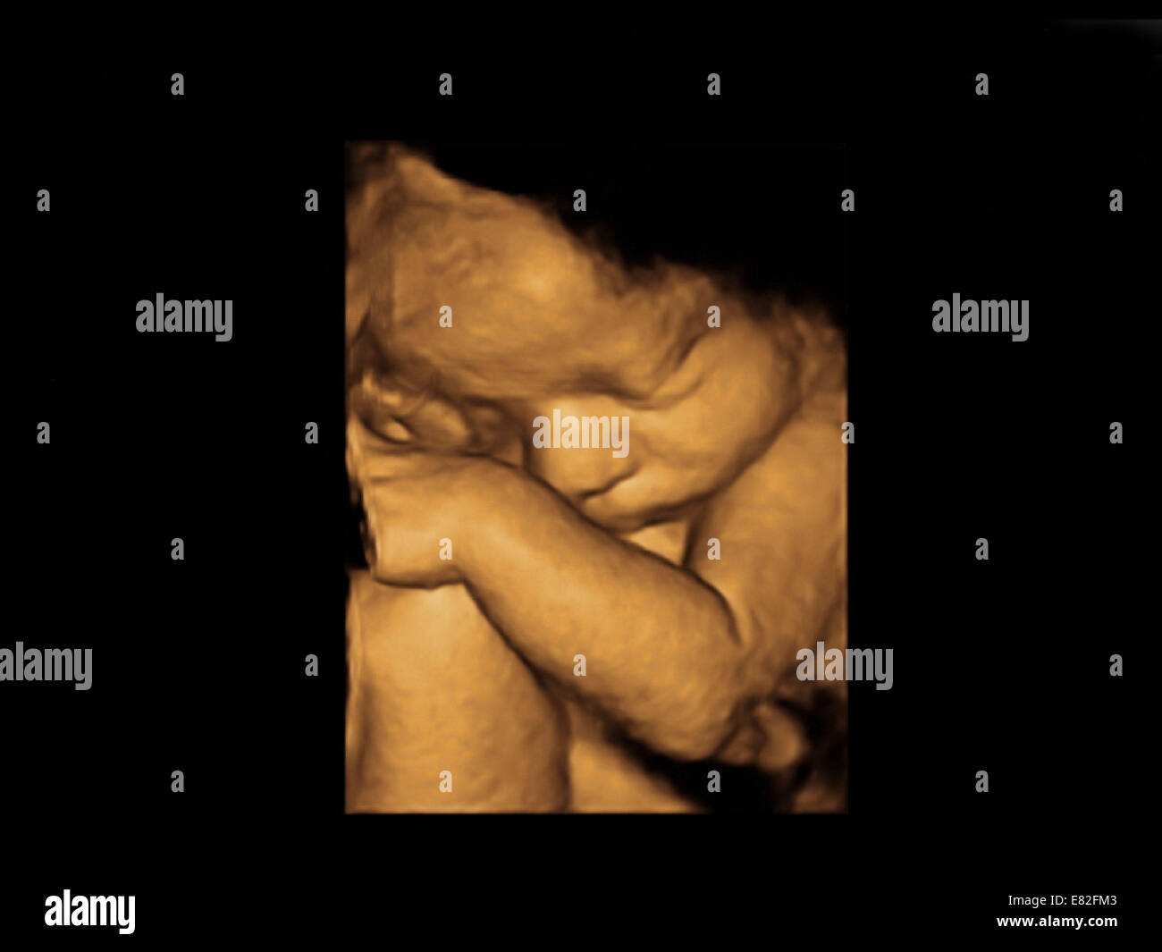 Fötus Gesicht, farbige 3-d-Ultraschalluntersuchung eines Fötus Gestationsalter: 36 Wochen und 6 Tage. Stockfoto