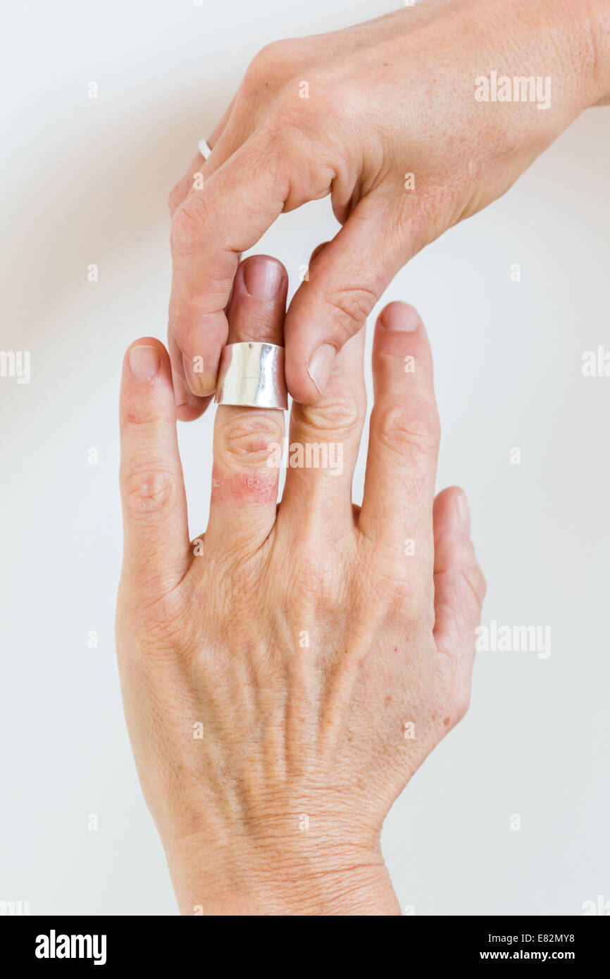 Kontaktdermatitis auf Finger. Stockfoto