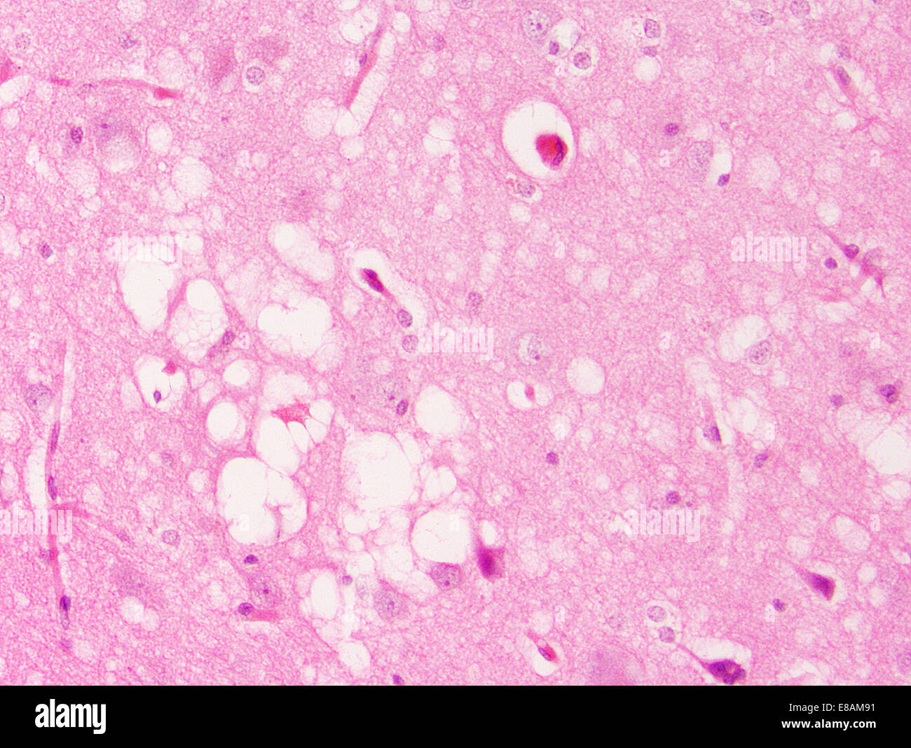 Prion-Krankheit, spongiforme Enzephalopathie Stockfoto