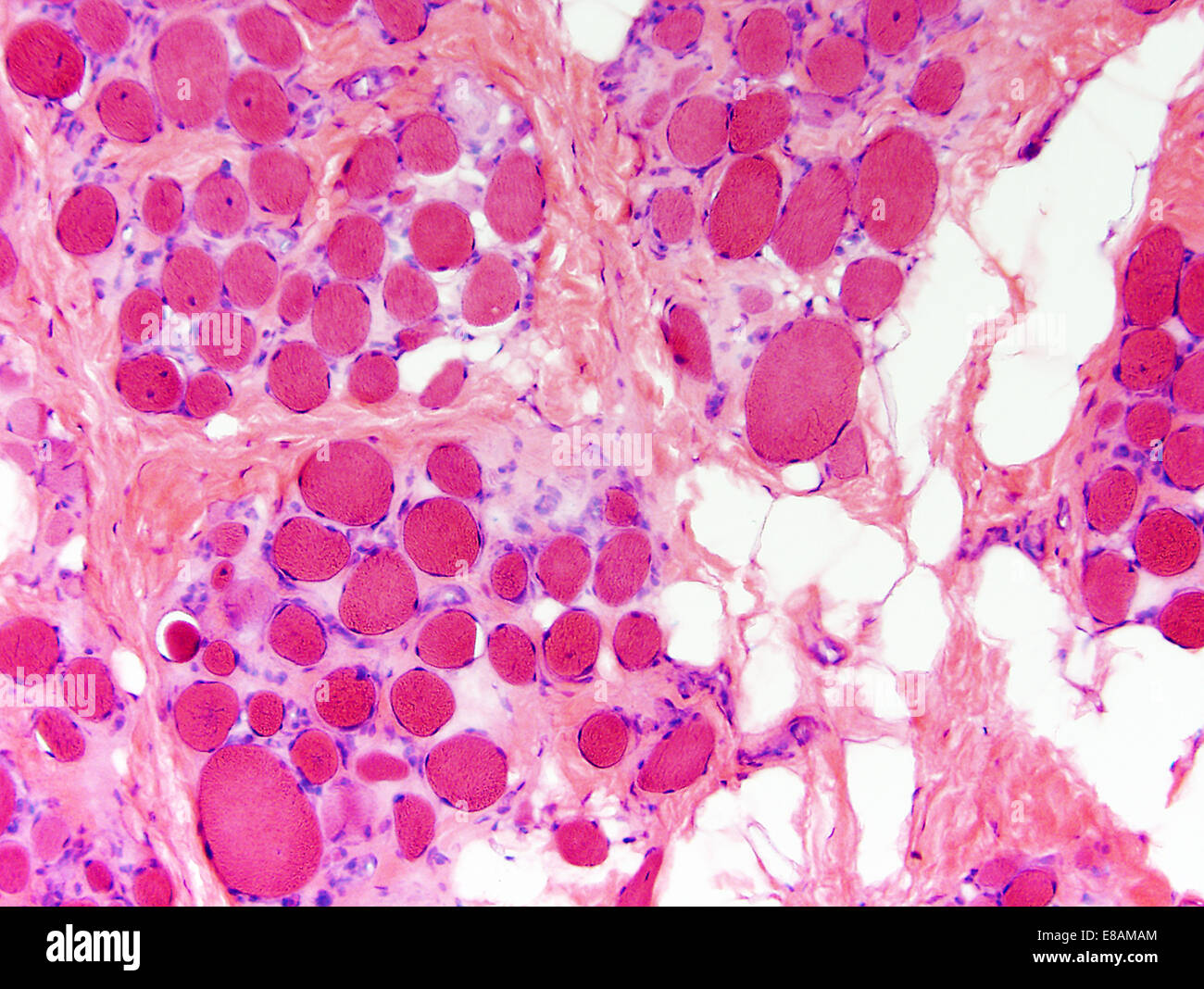 Muskulöse Dystrophie Stockfoto