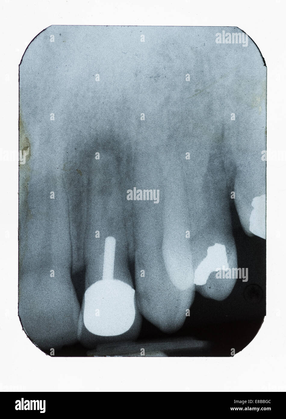 Dental Xray zeigt Füllungen Implantat und Dichte Knochenschwund Stockfoto