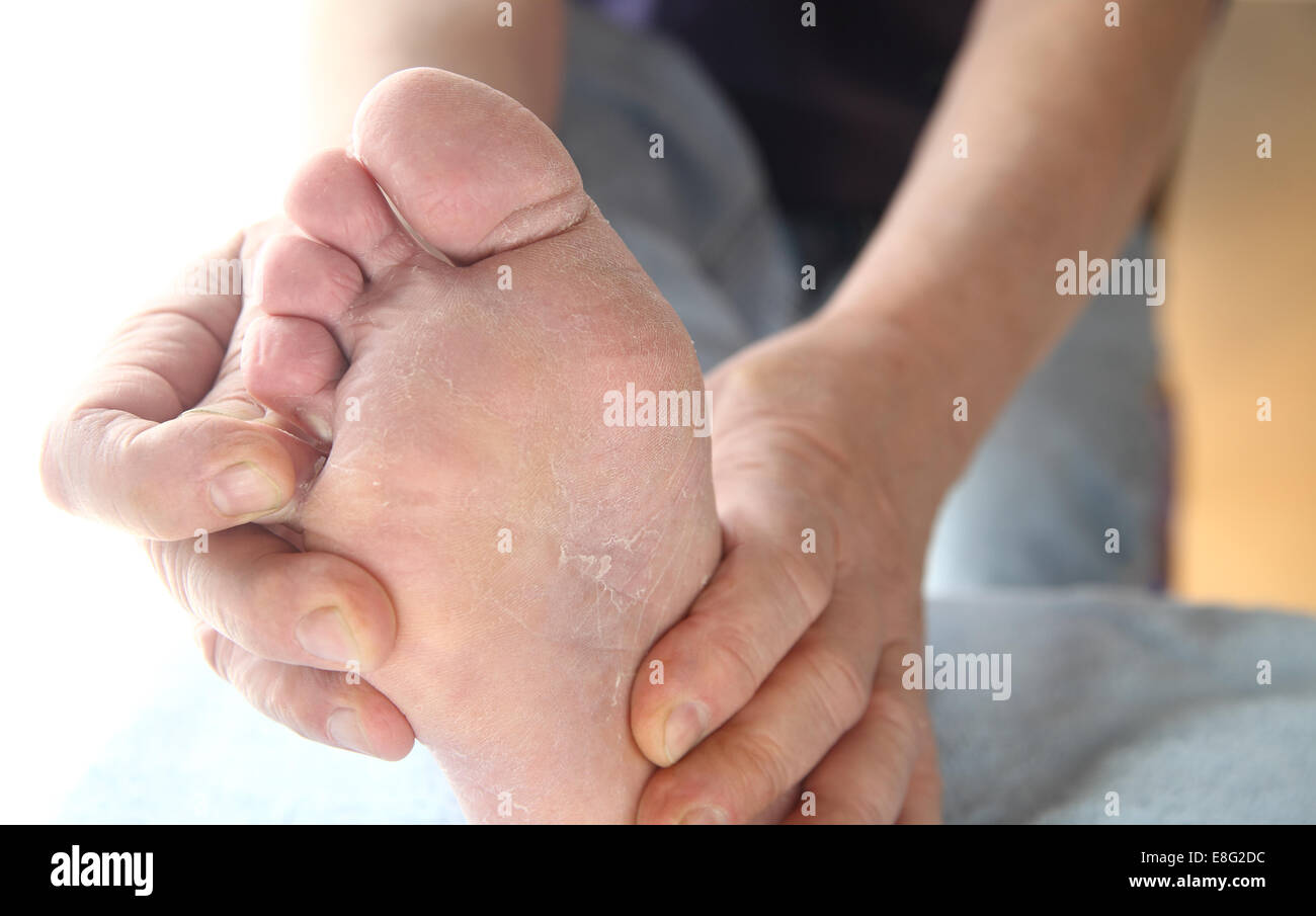 Ein Mann prüft die chemische peeling Haut von seinem Sportler Fußpilz zwischen den Zehen. Stockfoto