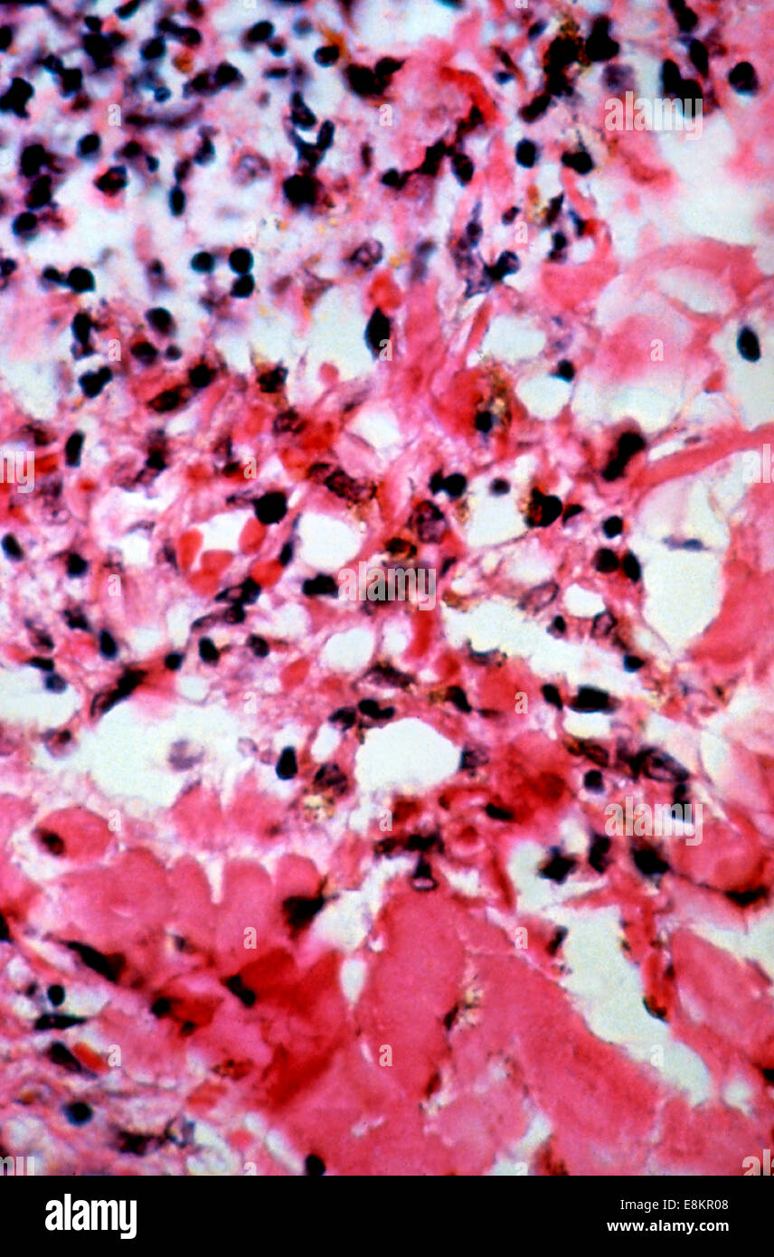 Das Schliffbild zeigt histologischen Veränderungen gefunden bei Kaposi s Sarkom Läsionen dieser Hautbiopsie der wie sich herausstellte Stockfoto
