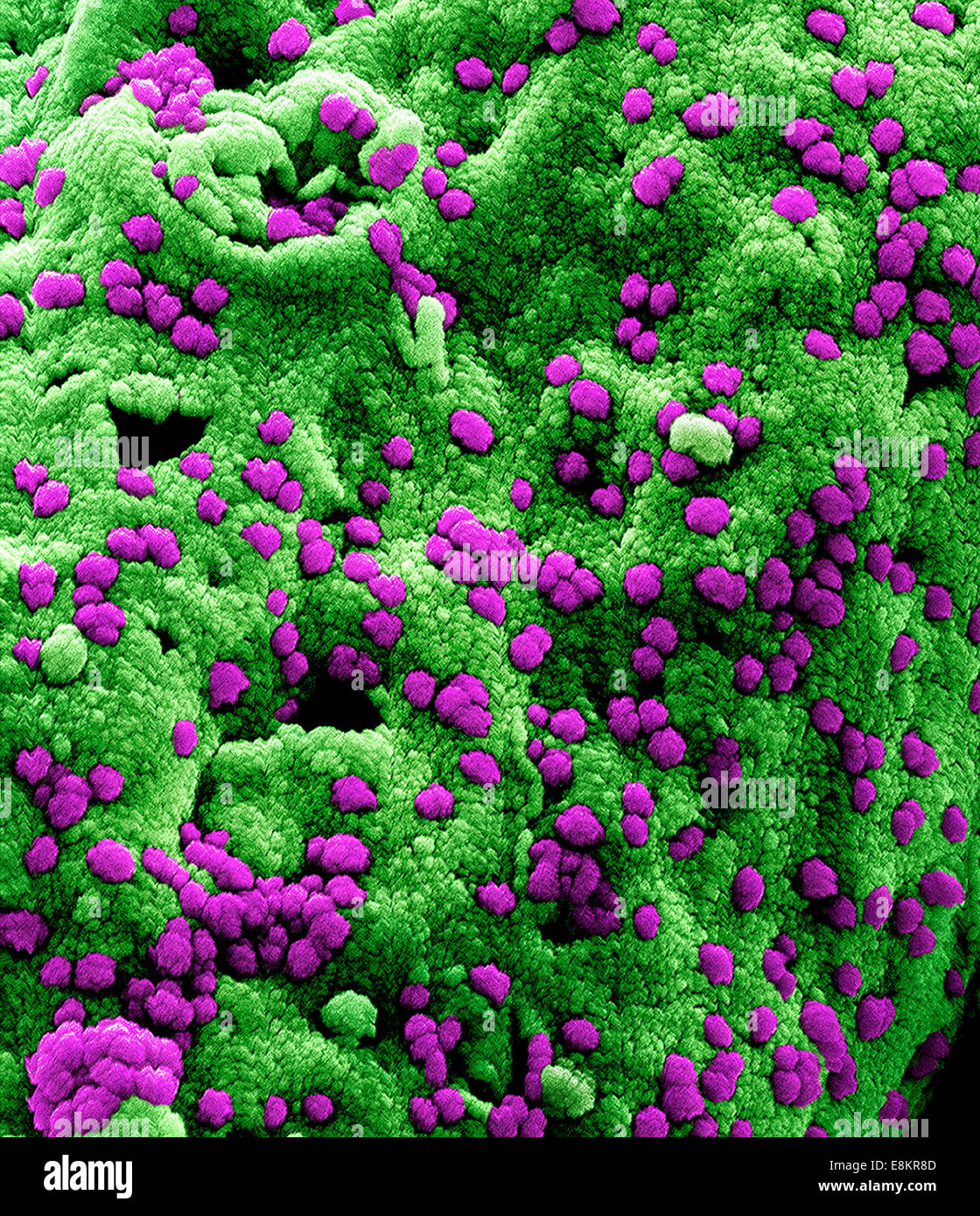 Eingefärbte scanning Electron Schliffbild der Middle Eastern respiratorische Syndrom Virus-Partikel an der Oberfläche befestigt ein Stockfoto