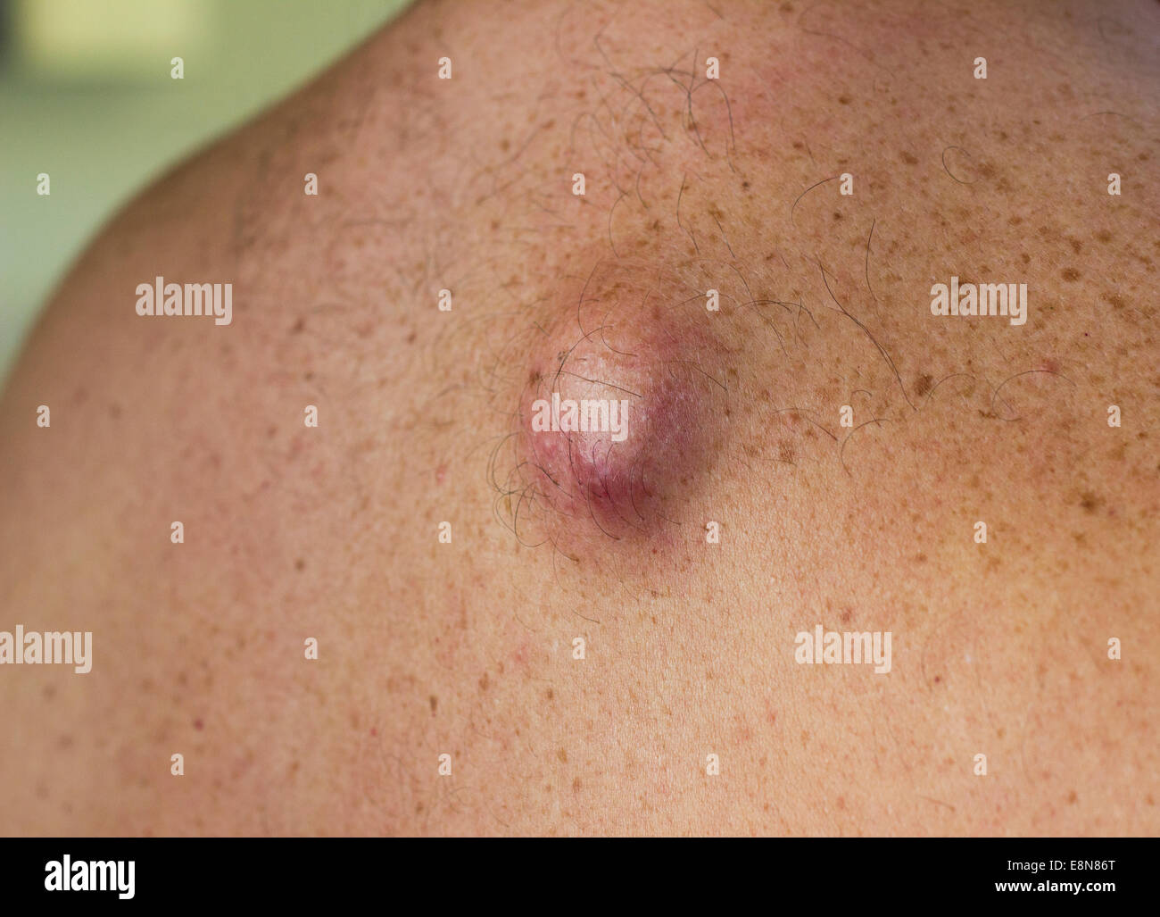 Eine infizierte Talgzyste auf dem Rücken eines kaukasischen Mannes Stockfoto