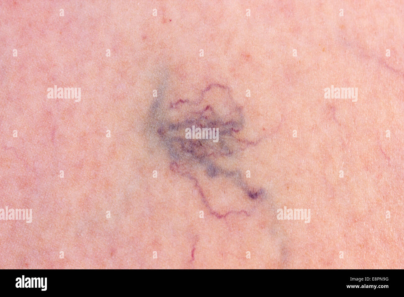 Lederhaut mit Krampfadern Stockfoto