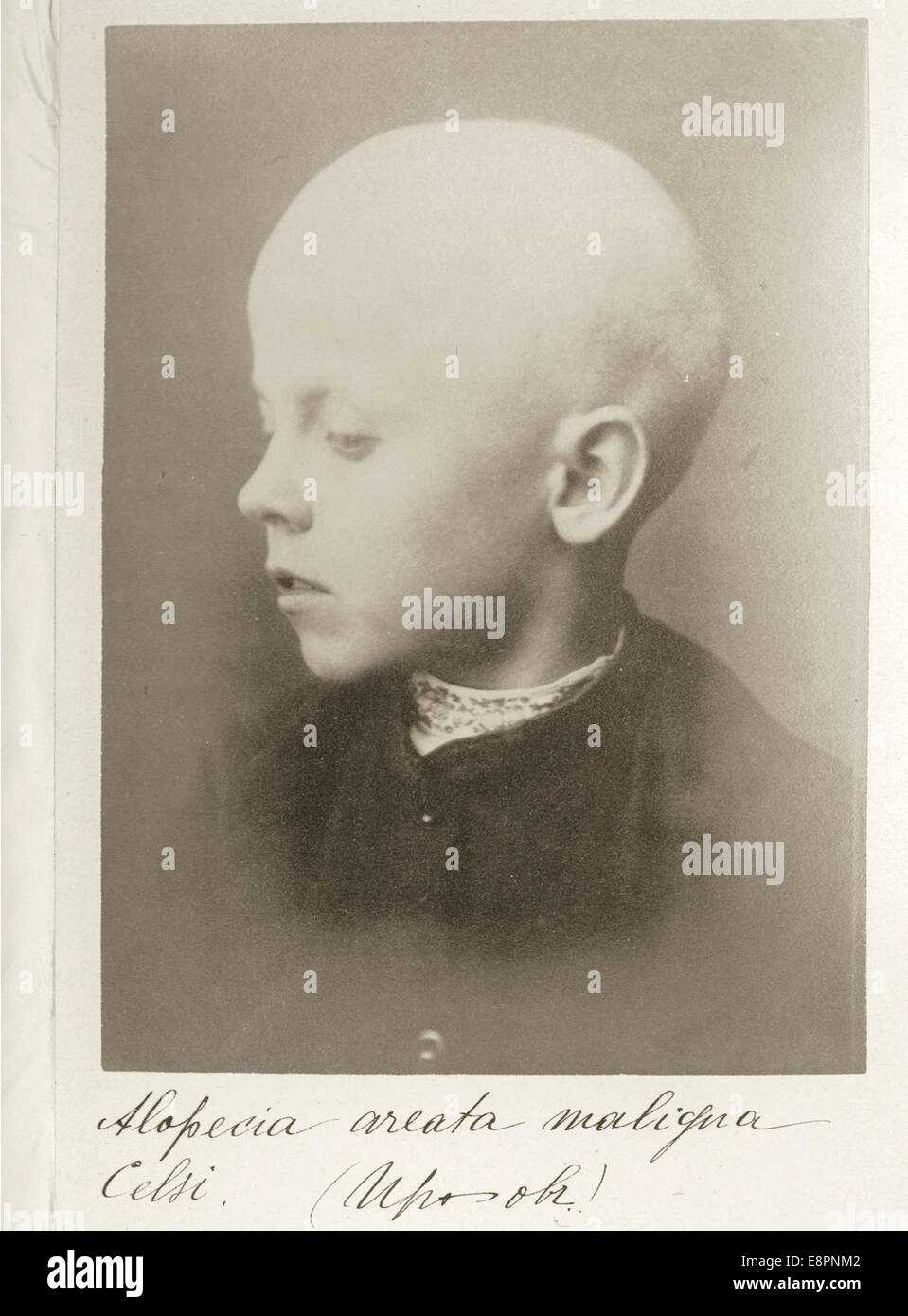 Foto eines neun-Jahr-alten Jungen bösartigen Haarausfall leiden; Alopecia Areata.    Bild Beschreibung: Photog Stockfoto