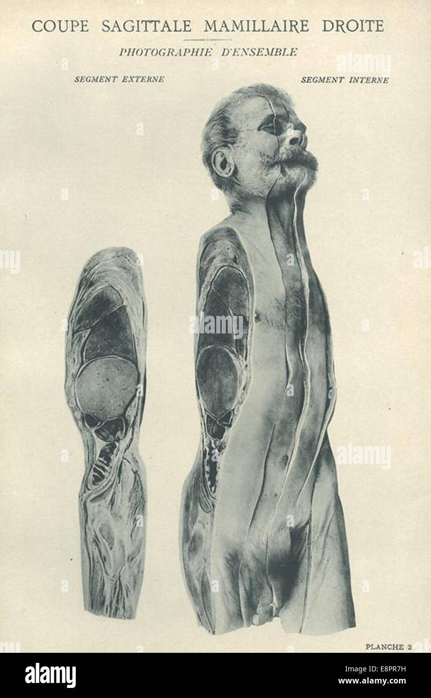 Ein Foto aus Eugene-Louis Doyens „Atlas d'Anatomie topographique“, das einen Querschnitt der rechten Seite des Körpers eines Mannes zeigt und die Brustdrüsen zeigt. Diese Arbeit, die für ihre Zeit bahnbrechend war, lieferte eine fotografische Dokumentation der menschlichen Anatomie. Stockfoto