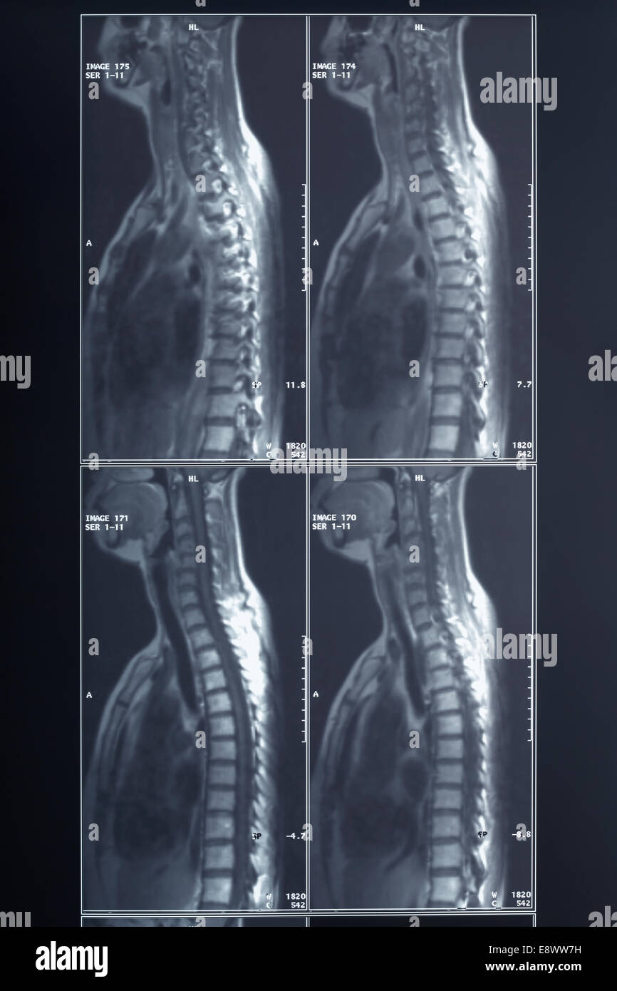 Röntgen Wirbelsäule und Nacken Stockfoto