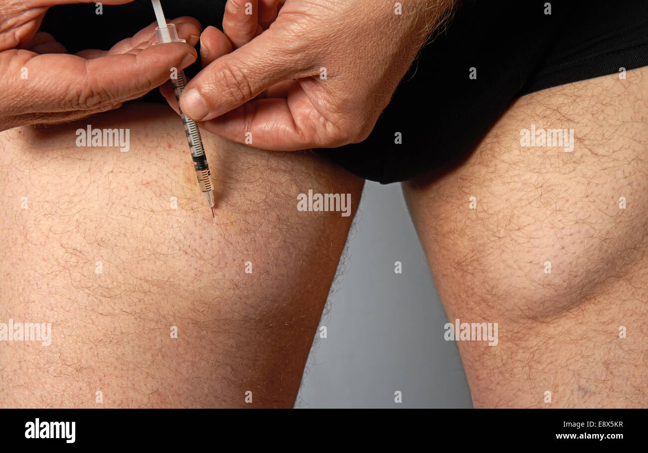 Diabetische Mann Insulininjektionen in seinem Bein, die im Laufe der Jahre Knoten unter der Haut verursacht hat Stockfoto